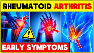 5 Early Signs And Symptoms of Rheumatoid Arthritis | Rheumatoid Arthritis First Symptoms