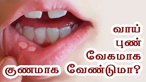 Mouth Ulcer Treatment at Home - Vaai Pun - Health Tips in Tamil