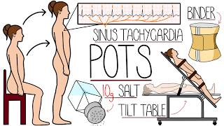 Postural Orthostatic Tachycardia Syndrome (POTS) Explained Clearly