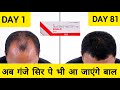 Finasteride 1mg Review | Finalo Tablet | Finasteride 1mg Results | Finasteride 1mg Tablets