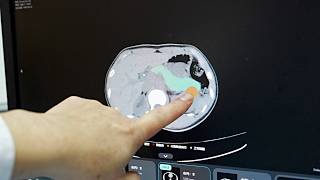 How A Chinese Ai Model Is Rewriting The Rules Of Pancreatic Cancer Detection