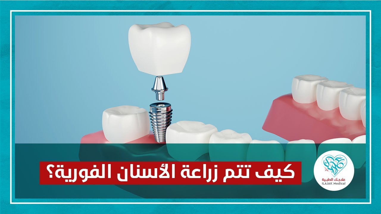 كيف تتم زراعة الأسنان الفورية بعد قلع الأسنان؟ #زراعة_الاسنان #زراعة_الاسنان_الفورية
