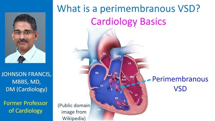 Atrioventricular block - Wikipedia