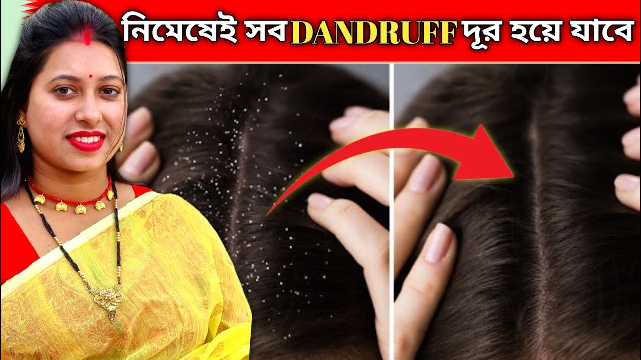 খুশকি দূর করার তিনটি ঘরোয়া উপায় | Dandruff remove at home | Dandruff treatment at home
