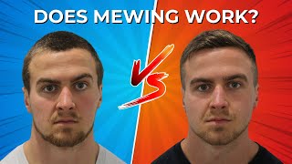 I Did Mewing Every Day For 2 Years