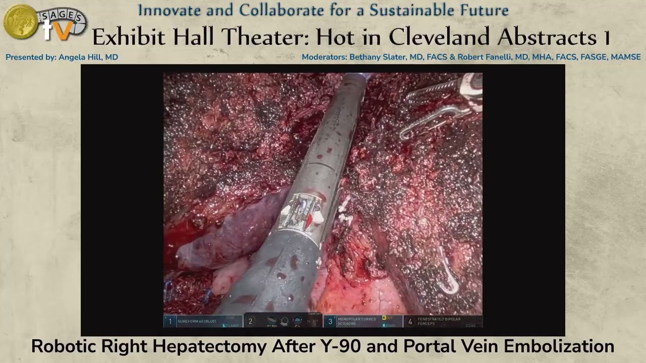 Robotic Right Hepatectomy After Y-90 and Portal Vein Embolization