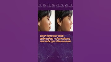 Mô phỏng quá trình niềng răng - Cảm nhận sự thay đổi qua từng milimet