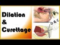 Dilation and curettage d  c