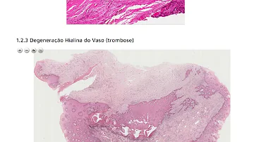 O que é degeneração gordurosa?