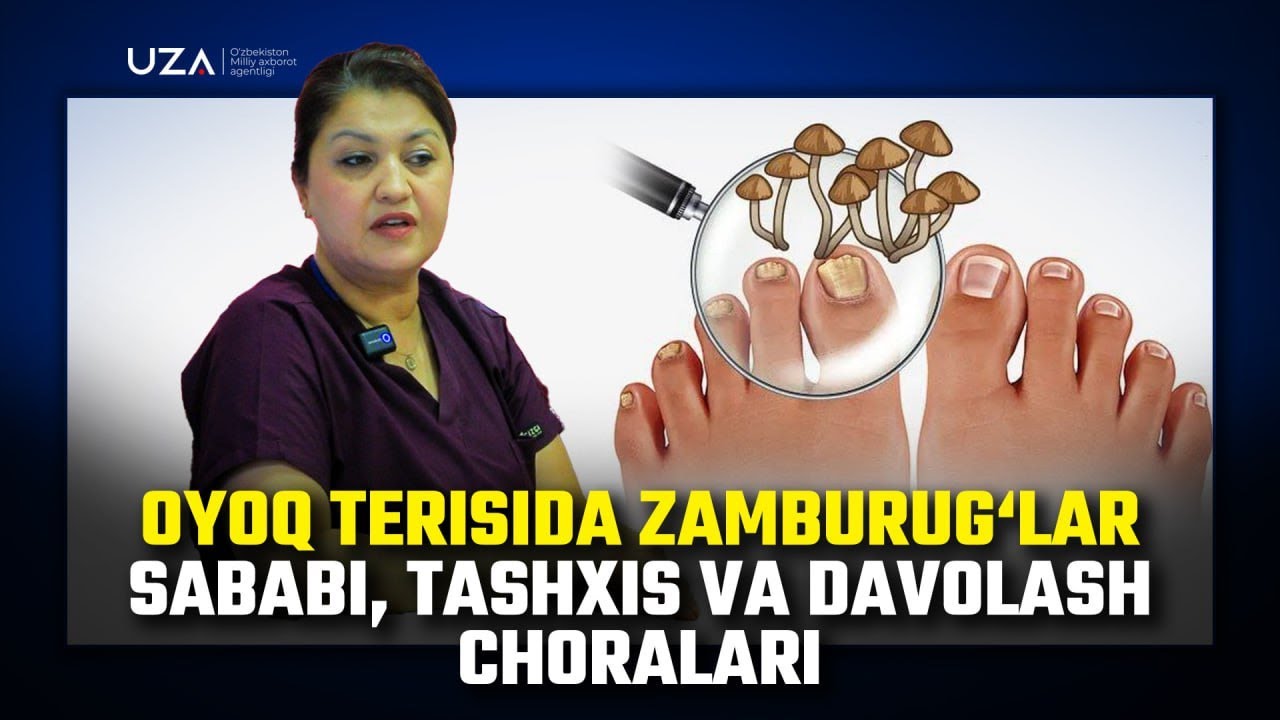 Oyoq terisida zamburug‘lar sababi, tashxis va davolash choralari