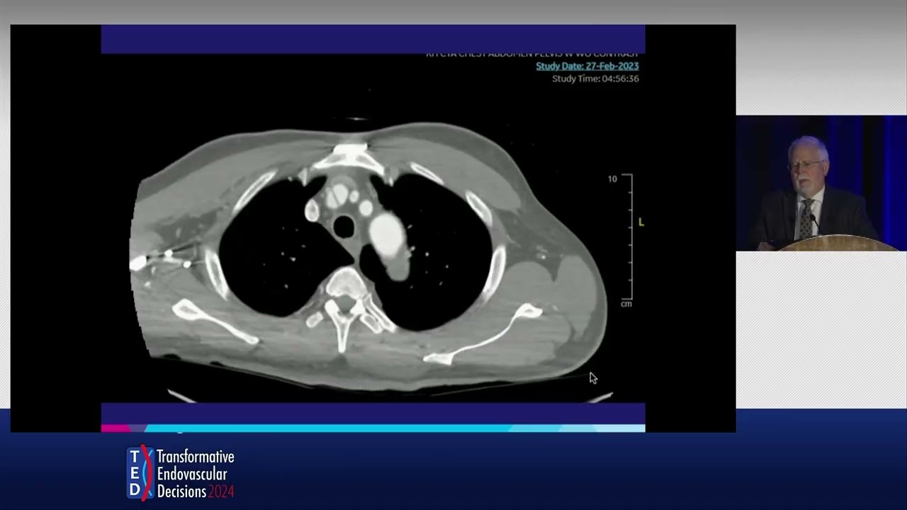 Innovations in Vascular Care with Gore Branched Devices | Dr. James F. McKinsey at TED 2024