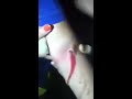 This Spooky Video Of A Girl Getting Her Blister Cut Open Is Weird And Bone-Shaking