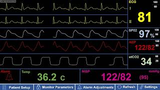 Simulated Adult Patient ICU Monitor with NSR (Normal Sinus Rhythm)
