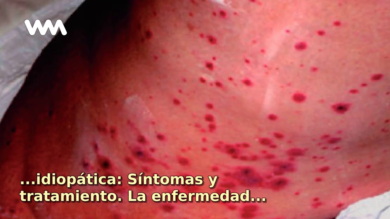 Púrpura trombocitopénica idiopática YouTube