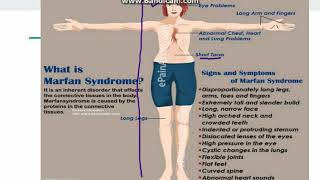 Marfan Syndrome