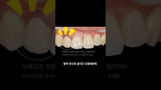자연스러운 지르코니아 크라운  #사람사랑치과 with CLOVA Dubbing