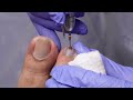 Satisfying release of blood blister underneath toenail
