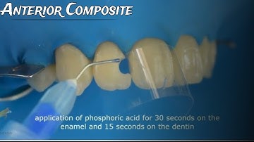 Class III Composite restoration Full case protocol from A to Z