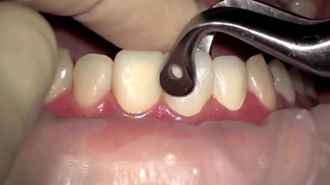 front tooth root canal