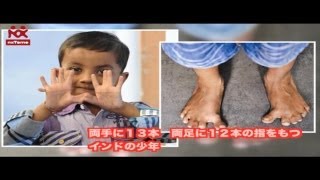 両手に１３本　両足に１２本の指をもつインドの少年