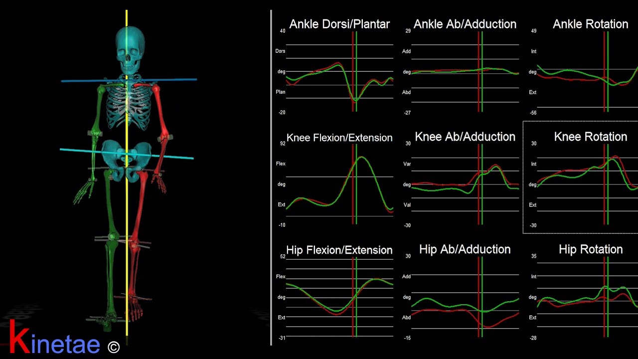 Niño de 9 años con asimetría: EID + Larga 2cm biomechanics of ankle joint