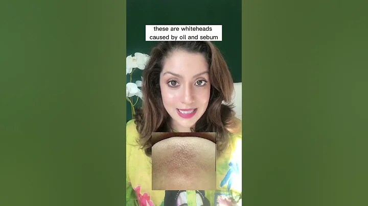 How to treat sebaceous filaments #shorts #shortsvideo - DayDayNews