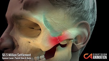 Mechanism of Injury Summary - Forensic Animation