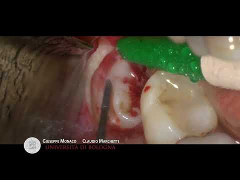 Video: Coronectomy: Kapan Itu Pilihan Terbaik Dan Mengapa