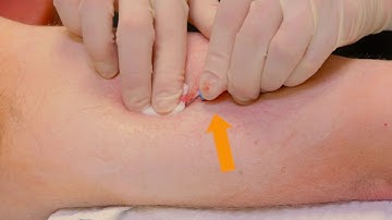 SecurAcath Removal Fold or Split Method with Catheter Removed