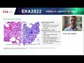 Updates in Advanced Systemic Mastocytosis from EHA 2022: Lessons learned in the diagnosis of ASM
