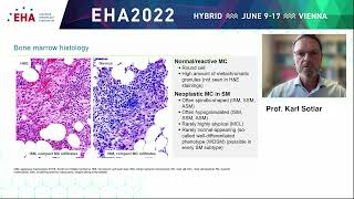 Updates in Advanced Systemic Mastocytosis from EHA 2022: Lessons learned in the diagnosis of ASM