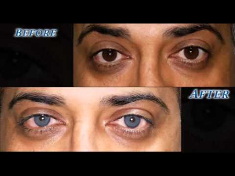 brightocular eye color change turquoise green by dr salman habash - Eye Color Change Surgery Before And After brightocular eye color change turquoise green by dr salman habash - Eye Color Change Surgery Before And After