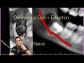 Dentigerous cyst and lower wisdom tooth with four roots watch my podcast drwahanexperiment