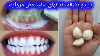 چگونه دندانهای سفید مثل مروارید داشته باشیم