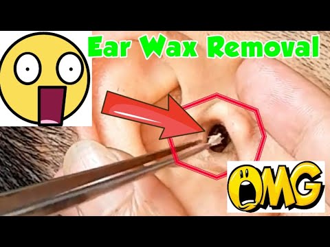 How Ear Wax is Professional Extracted - Get Rid of Ear Wax Buildup Removal - Milia Ear Wax