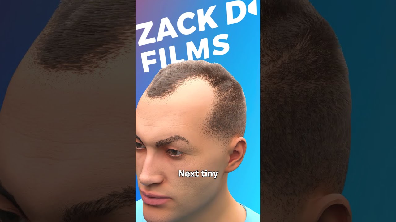 How Hair Transplants Work 