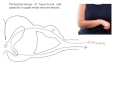 Pathophysiology of spasticity following UMN lesions