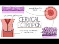 Understanding Cervical Ectropion / Cervical Erosion