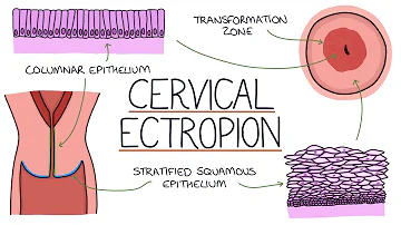 Quando sanguina il collo dell'utero?