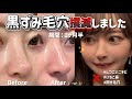【加工なし❌】10年以上悩んだ鼻の黒ずみ毛穴を1ヶ月半で撲滅した方法5選!#肌管理 #スキンケア #内服