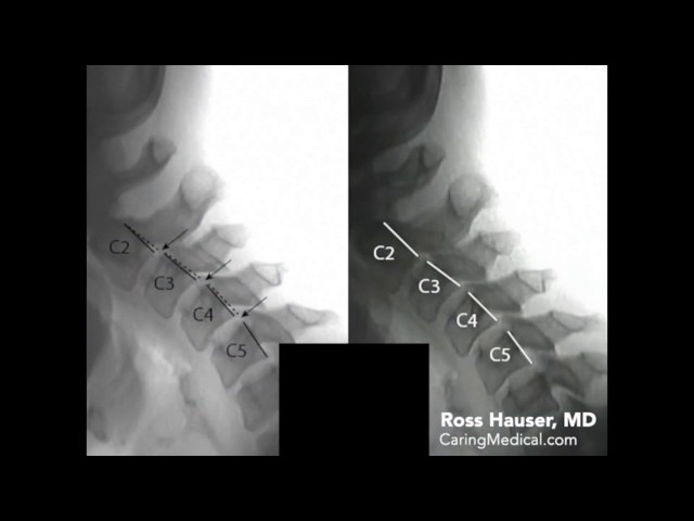 Improvement of cervical anterolisthesis- DMX review with Ross Hauser, MD class=