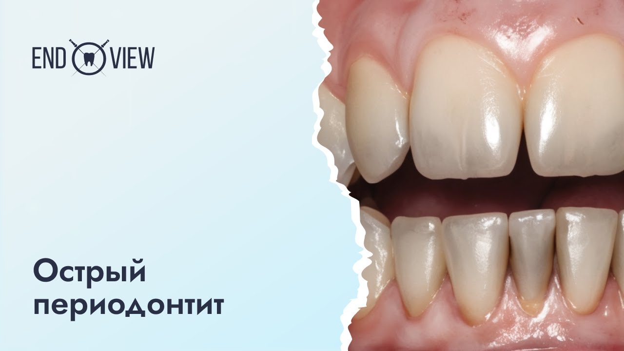 Острый периодонтит - причины, симптомы и лечение