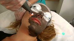 Spectra Laser "Hollywood Peel" Treatment at Premier Laser Clinic 
