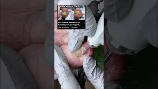 Ногти бабушки. Онихогрифоз. Грибок ногтей