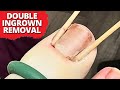 Double Ingrown Nail Removal On a 12-Year-Old Patient!