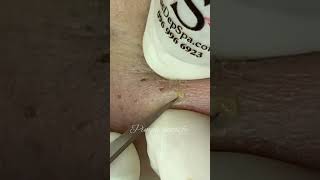 Picking my blackhead🎥 @pimple.satisfy2894  #pimpleproblem #blackheads