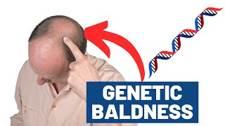 Are YOU Destined to Go BALD? Baldness Genes REVEALED