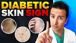Your Skin Can Be Devastated By Diabetes!