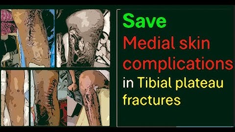 Avoiding medial wound complications in Tibial Plateau (proximal tibia) fractures