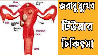 জরায়ুর টিউমার কি | জরায়ু টিউমারের লক্ষণ | uterus tumor | হোমিওপ্যাথিতে জরায়ু টিউমারের চিকিৎসা